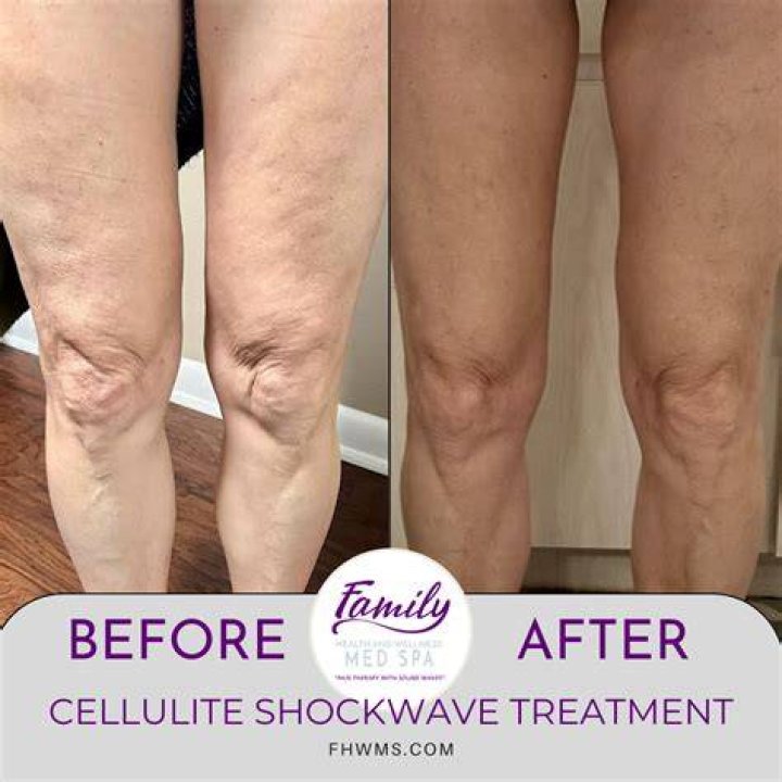 Best Lotion to Reduce Cellulite: Unlock Your Smooth Skin Potential