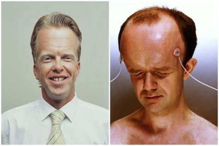 Man with Biggest Forehead: Discovering the Fascinating Story Behind This Remarkable Trait