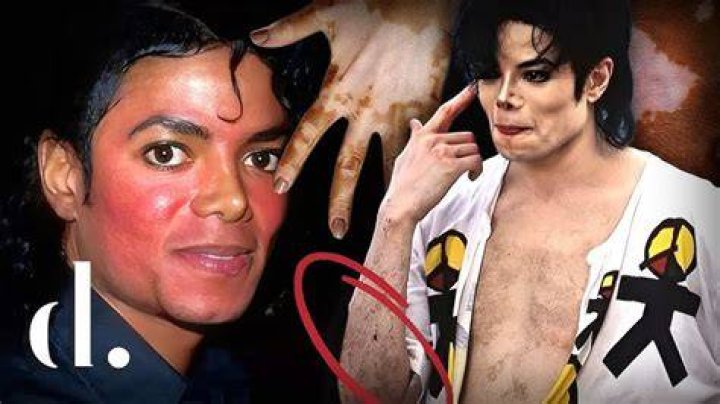 Michael Jackson's Battle with Vitiligo: A Comprehensive Look into His Journey