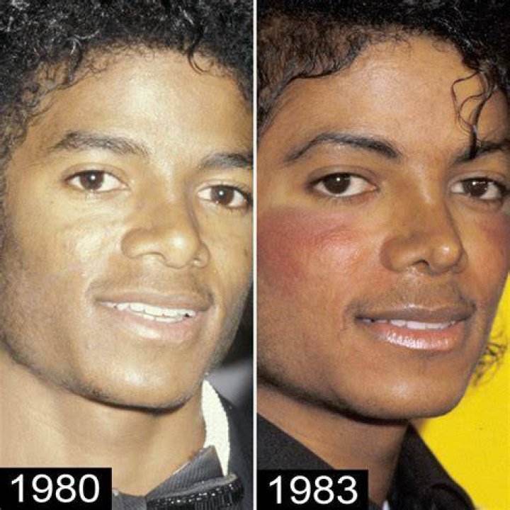 Michael Jackson's Nose Surgery: A Deep Dive into the King of Pop's Iconic Journey