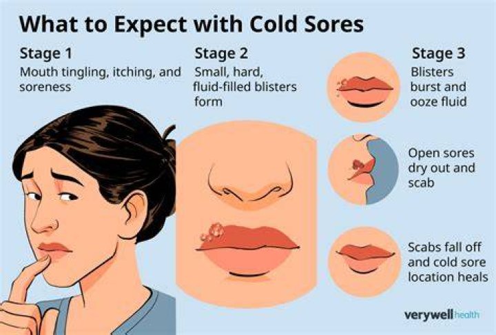 Should I Pop Cold Sores? A Comprehensive Guide to Understanding and Treating Cold Sores