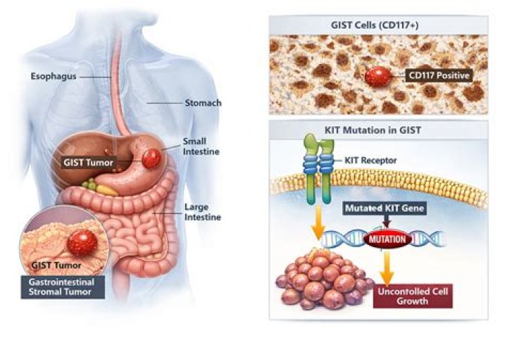 What Cancer Did Marcia Clark Have? Unveiling Her Journey with Gastrointestinal Stromal Tumor (GIST)